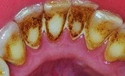 Πώς να αφαιρέσετε την οδοντική πλάκα χωρίς να πάτε στον οδοντίατρο!