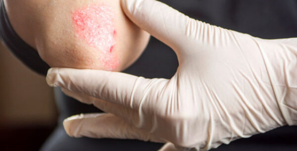 Ψωρίαση: Το καθαρό δέρμα είναι ένας εφικτός στόχος