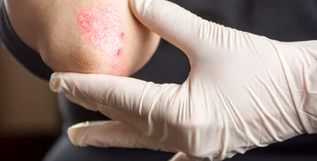 Ψωρίαση: Το καθαρό δέρμα είναι ένας εφικτός στόχος