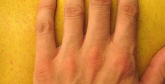 Που μπορεί να οφείλεται η κίτρινη χροιά στην όψη του δέρματος