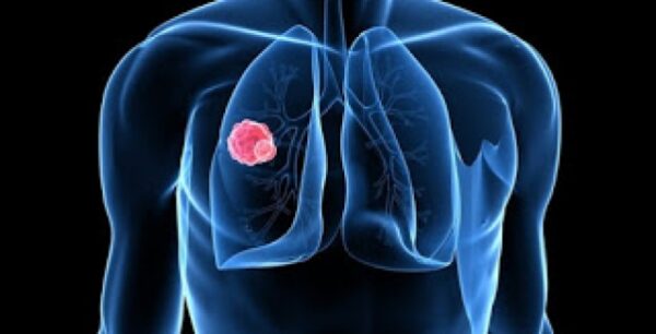 Δραματική πρόβλεψη: Μέσα σε 15 χρόνια οι θάνατοι από καρκίνο θα διπλασιαστούν