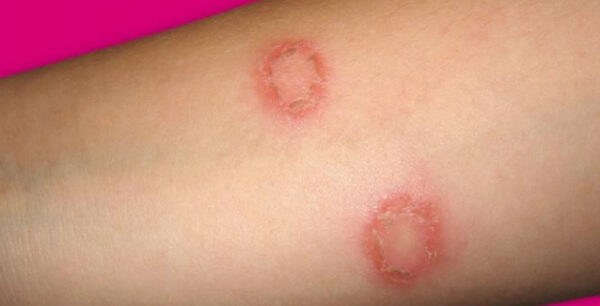 Προσοχή αν δείτε τέτοια σημάδια στο δέρμα σας. Εξαιρετικά μεταδοτική πάθηση