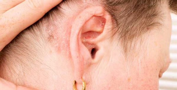 Ενημερωτική εκδήλωση για την ψωρίαση και την ψωριασική αρθρίτιδα