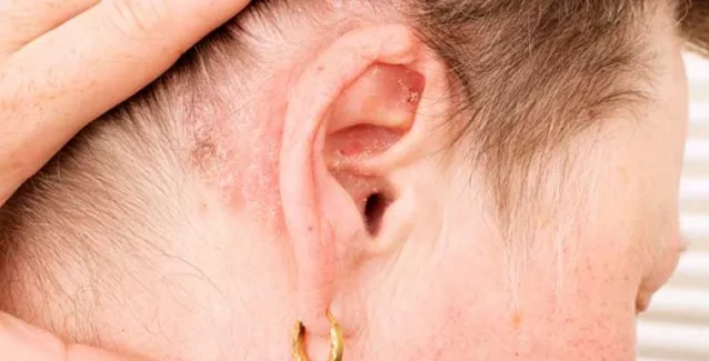 Ενημερωτική εκδήλωση για την ψωρίαση και την ψωριασική αρθρίτιδα