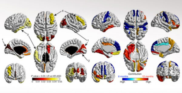 Αλγόριθμος διαβάζει τον εγκέφαλο των βρεφών και προβλέπει τον αυτισμό