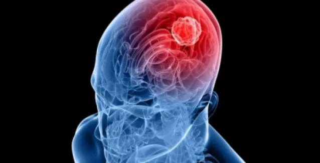 Αυτά τα συμπτώματα προδίδουν ανεύρυσμα στον εγκέφαλο