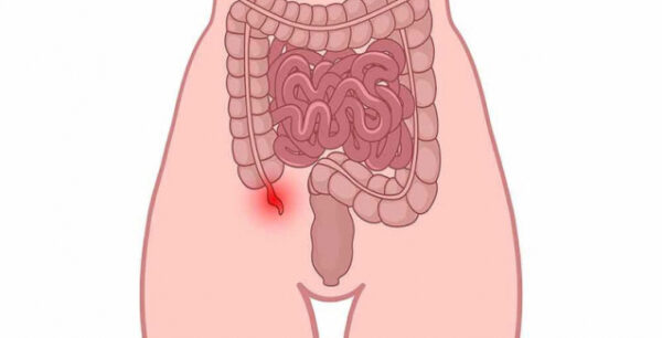 Ρήξη σκωληκοειδούς απόφυσης: 5 προειδοποιητικά σημάδια που πρέπει να γνωρίζετε