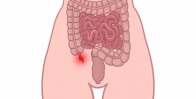 Ρήξη σκωληκοειδούς απόφυσης: 5 προειδοποιητικά σημάδια που πρέπει να γνωρίζετε