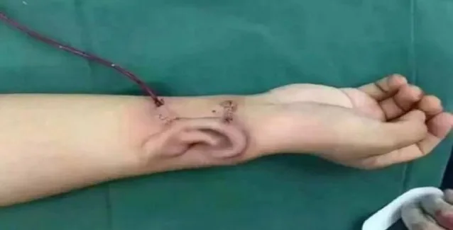 «Kαλλιεργήσαν» μόσχευμα αυτιού στο μπράτσο ασθενούς (φωτό)