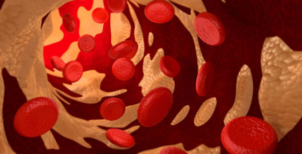 Χοληστερόλη LDL, HDL, VLDL, ολική: Ποιες είναι οι φυσιολογικές τιμές