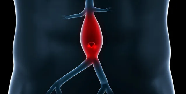 Ανεύρυσμα κοιλιακής αορτής: Όλα όσα πρέπει να γνωρίζετε