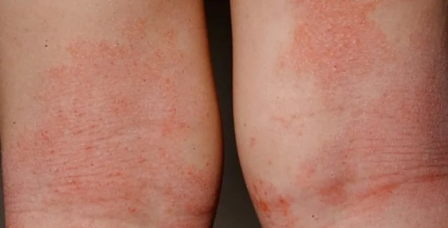 Οι επιπτώσεις της ατοπικής δερματίτιδας στην ποιότητα ζωής