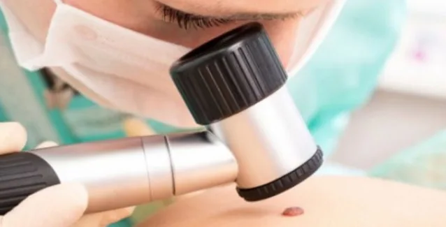 Καρκίνος του δέρματος: Πιο επικίνδυνο το μελάνωμα για τους καπνιστές