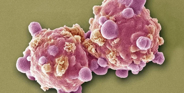 Λευχαιμία: Τα 6 σημάδια που πρέπει να γνωρίζουν οι γυναίκες