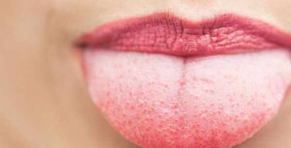 Εσείς βουρτσίζετε τη γλώσσα σας; Δείτε γιατί πρέπει να το κάνετε