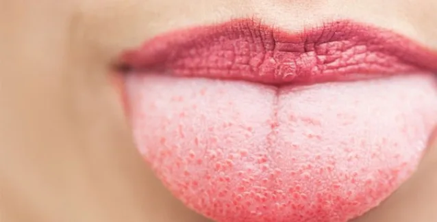 Εσείς βουρτσίζετε τη γλώσσα σας; Δείτε γιατί πρέπει να το κάνετε