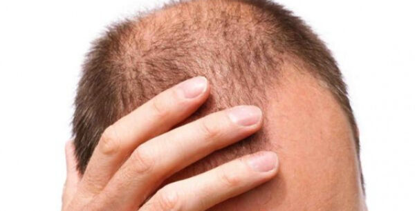 Γιατί οι κοντοί άνδρες χάνουν τα μαλλιά τους πριν την ώρα τους;