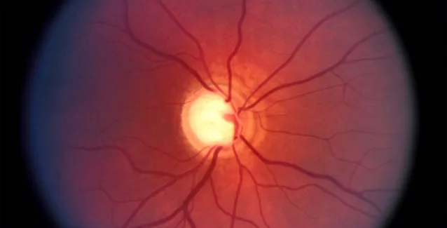 Γλαύκωμα: Οι άνθρωποι φοβούνται την απώλεια όρασης, αλλά δεν επισκέπτονται τον οφθαλμίατρο