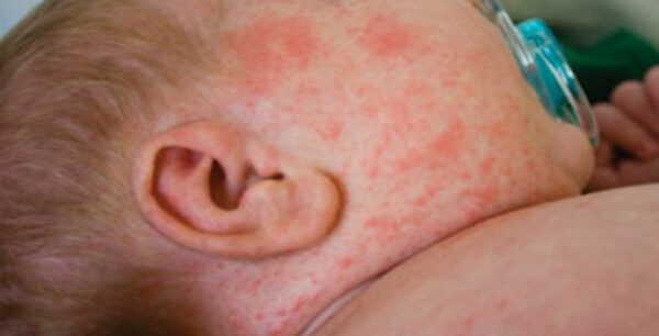 Η επιδημία ιλαράς εξαπλώνεται σε όλη την Ευρώπη- Ανησυχία από τον ΠΟΥ