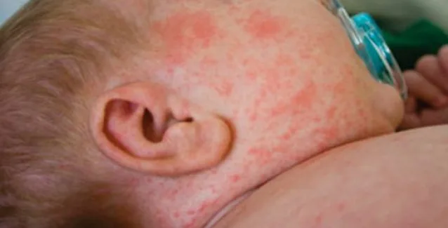 Η επιδημία ιλαράς εξαπλώνεται σε όλη την Ευρώπη- Ανησυχία από τον ΠΟΥ