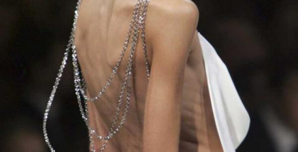 Πειραματική ηλεκτροθεραπεία στον εγκέφαλο κατά της νευρικής ανορεξίας