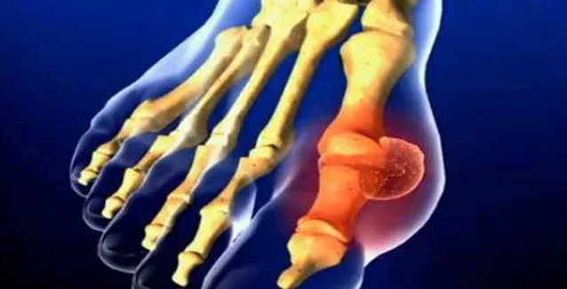 5 ερωτήσεις για το ουρικό οξύ