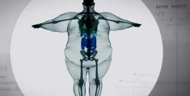 Παχυσαρκία και καρκίνος: Νέα δεδομένα για το πώς συνδέονται