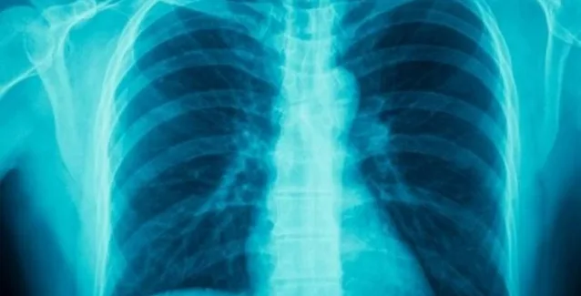 Ελληνική Πνευμονολογική Εταιρεία: Μονόδρομος η καθολική απαγόρευση του καπνίσματος