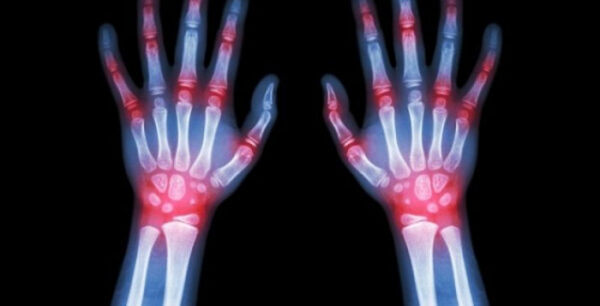 Ρευματοειδής αρθρίτιδα: Τρεις τρόποι για να ανακουφιστείτε από τα συμπτώματα