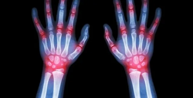 Ρευματοειδής αρθρίτιδα: Τρεις τρόποι για να ανακουφιστείτε από τα συμπτώματα