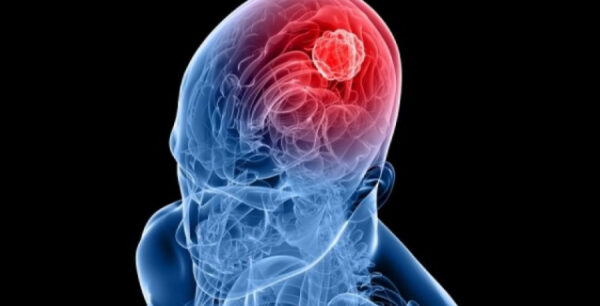 Ένοχα συμπτώματα καρκίνου του εγκεφάλου -Αίτια και παράγοντες κινδύνου (βίντεο)