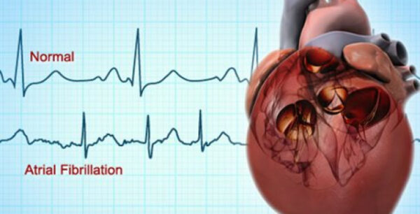 Από κολπική μαρμαρυγή κινδυνεύουν οι μεγαλόσωμες γυναίκες