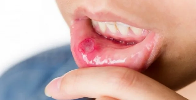 Αφθες στο στόμα: Ποιες παθήσεις μπορεί να κρύβουν
