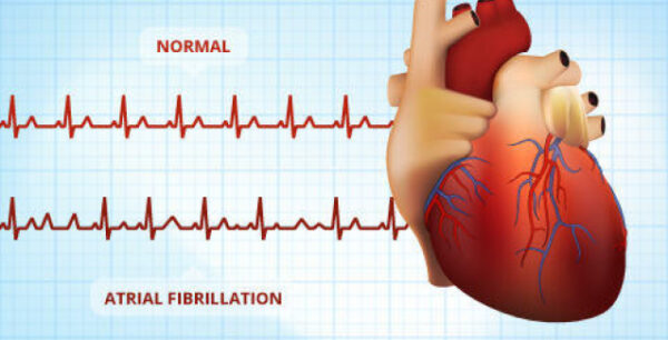 Κολπική μαρμαρυγή, μια “ύπουλη” αρρυθμία