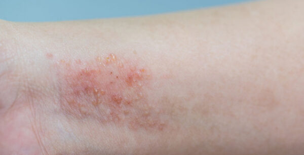 Ατοπική δερματίτιδα: Αίτια, συμπτώματα, αντιμετώπιση