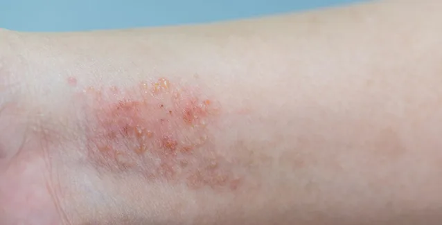 Ατοπική δερματίτιδα: Αίτια, συμπτώματα, αντιμετώπιση