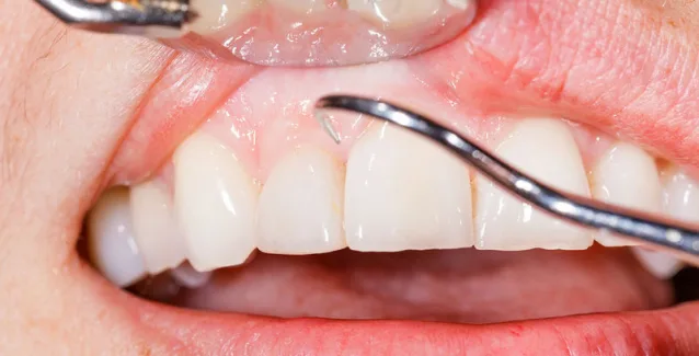 Διαβήτης: Οι επιπτώσεις του στη στοματική υγεία