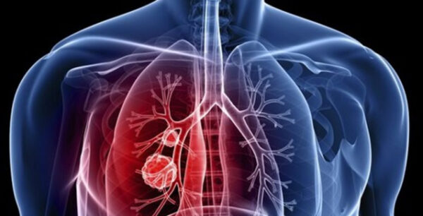 Νέο τεστ αίματος προβλέπει την επανεμφάνιση του καρκίνου των πνευμόνων