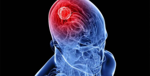 Ερευνα: Ενα σοβαρό τραύμα στο κεφάλι αυξάνει τον κίνδυνο άνοιας ακόμη και μετά από δεκαετίες