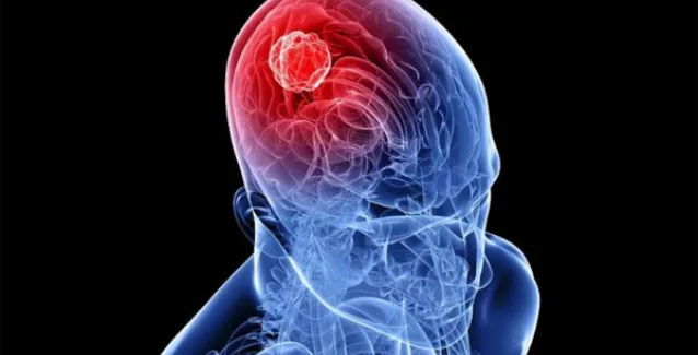 Όγκος στο κεφάλι: Προσοχή σε συμπτώματα, αίτια και παράγοντες κινδύνου