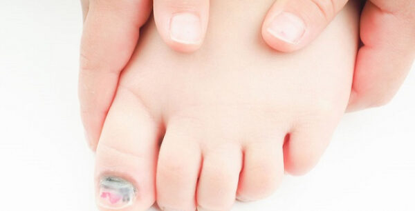 12 φυσικές θεραπείες για το μύκητα των νυχιών