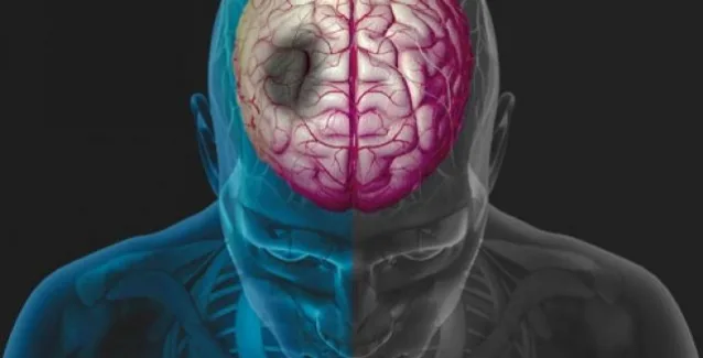Αυτά είναι τα 5 συμπτώματα εγκεφαλικού και αφορούν όλες τις ηλικίες