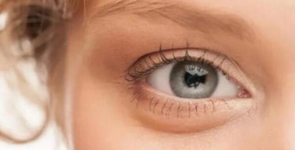 Κριθαράκι στο μάτι: Θεραπείες και πρόληψη