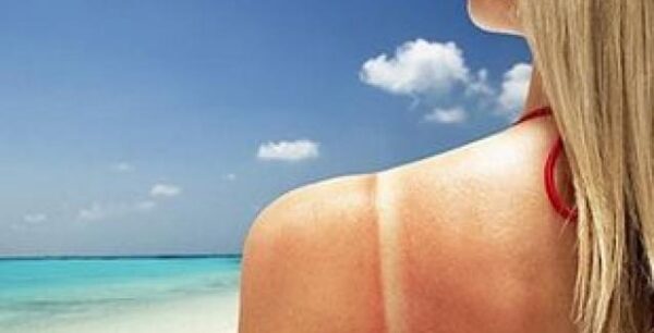 Ηλιοθεραπεία: Τι να κάνετε άμεσα αν πάθετε ηλιακό έγκαυμα