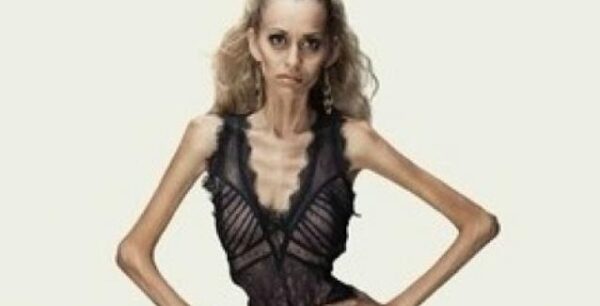 Νευρική ανορεξία: Τα συμπτώματα μιας ύπουλης διατροφικής διαταραχής