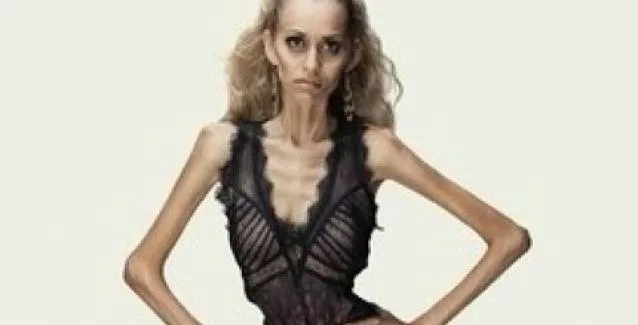 Νευρική ανορεξία: Τα συμπτώματα μιας ύπουλης διατροφικής διαταραχής