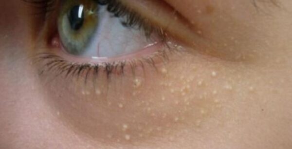 Γιατί δεν πρέπει να αγνοούμε τα λευκά σημάδια κάτω από τα μάτια;