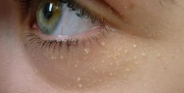 Γιατί δεν πρέπει να αγνοούμε τα λευκά σημάδια κάτω από τα μάτια;