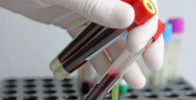 Τι είναι η C-αντιδρώσα πρωτεΐνη και γιατί σε εμποδίζει να αδυνατίσεις;