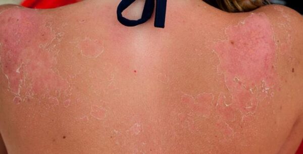 «Βούτυρο για το έγκαυμα» και άλλοι καλοκαιρινοί μύθοι για την υγεία της επιδερμίδας